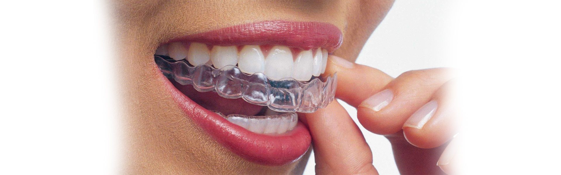 Teeth Straightening with Invisalign: How it Works