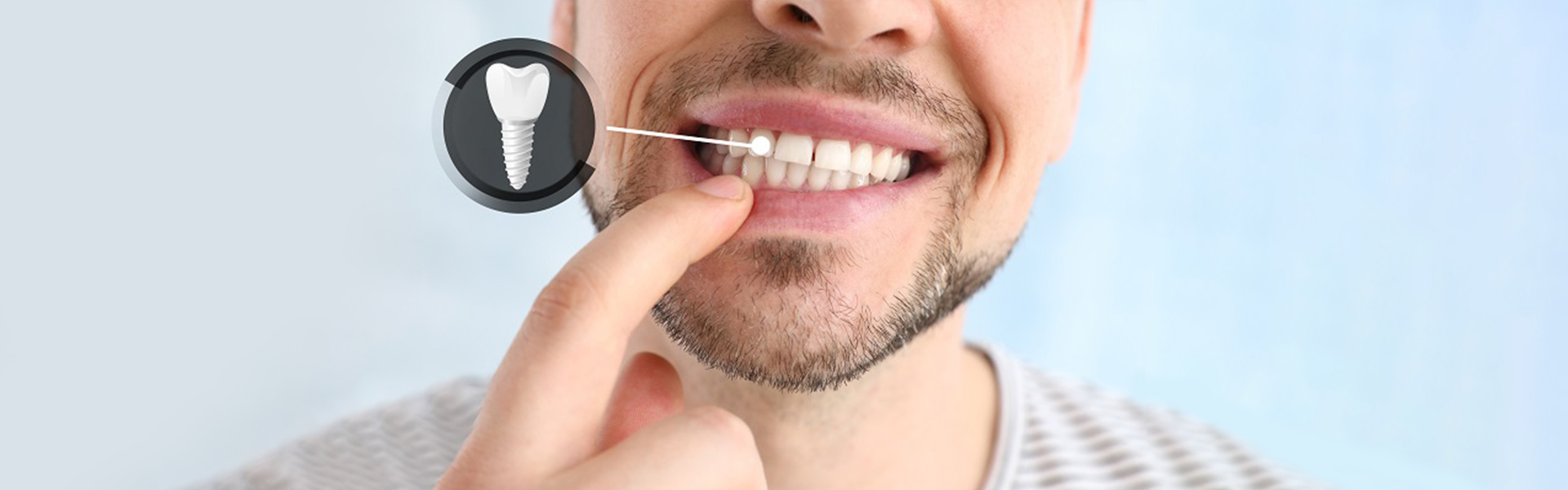 Expert Tips for Affordable Dental Implants in Seminole